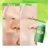 Blackhead Removal & Oil Control Solution